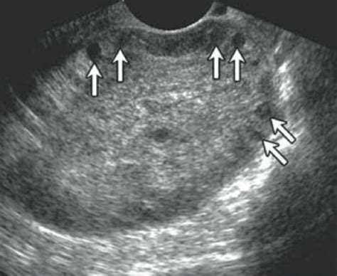 test for ovarian torsion|ovarian torsion precautions patient education.